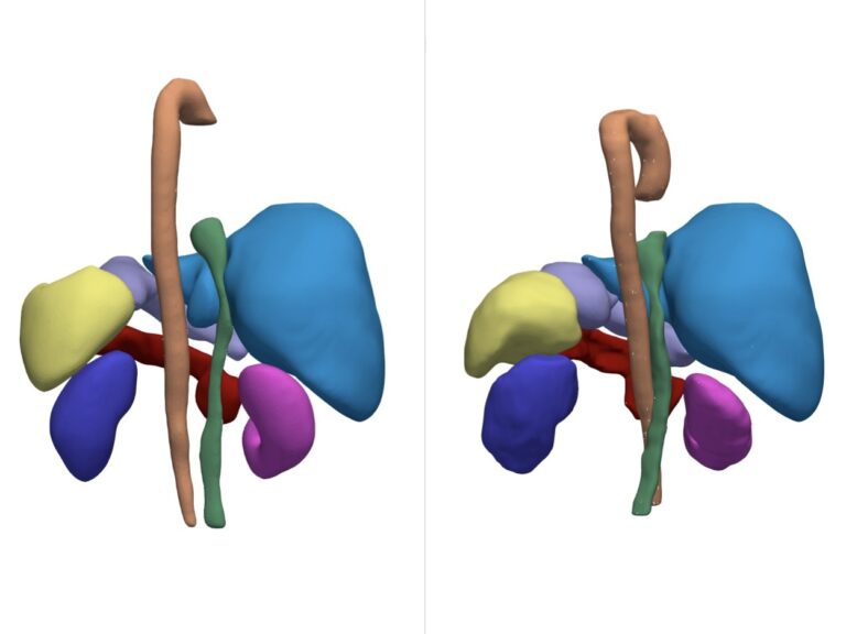 Organ Mix and Match: Data Augmentation for 3D Abdominal Organ Sets